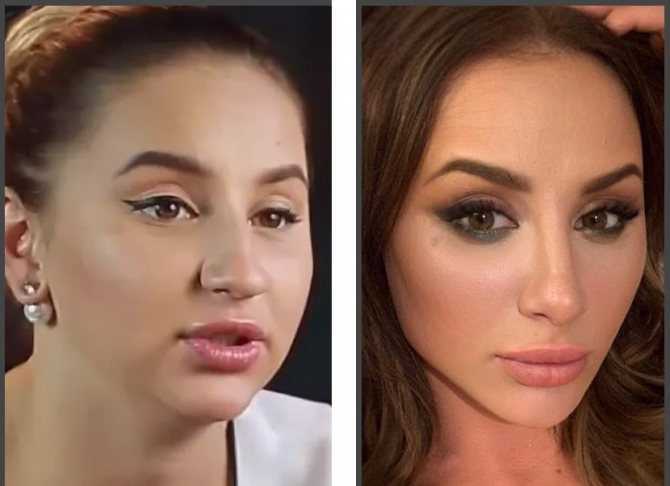 Асти до и после пластики